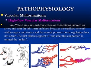 PATHOPHYSIOLOGYPATHOPHYSIOLOGY
 Vascular Malformations:Vascular Malformations:
 High-flow Vascular MalformationsHigh-flow Vascular Malformations
 An AVM is an abnormal connection or connections between anAn AVM is an abnormal connection or connections between an
artery and vein .In this situation blood bypasses the capillary networkartery and vein .In this situation blood bypasses the capillary network
within organs and tissues and the normal pressure down regulation doeswithin organs and tissues and the normal pressure down regulation does
not occur. The ﬁrst dilated segment of vein after this connection isnot occur. The ﬁrst dilated segment of vein after this connection is
termed thetermed the “nidus”.“nidus”.
 