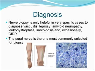 Diagnosis Nerve biopsy is only helpful in very specific cases to diagnose vasculitis, leprosy, amyloid neuropathy, leukodystrophies, sarcoidosis and, occasionally, CIDP The sural nerve is the one most commonly selected for biopsy 