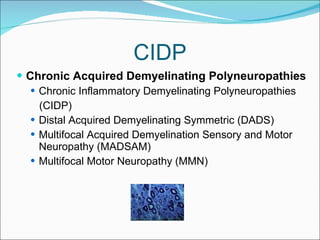 CIDP Chronic Acquired Demyelinating Polyneuropathies Chronic Inflammatory Demyelinating Polyneuropathies (CIDP) Distal Acquired Demyelinating Symmetric (DADS) Multifocal Acquired Demyelination Sensory and Motor Neuropathy (MADSAM) Multifocal Motor Neuropathy (MMN) 
