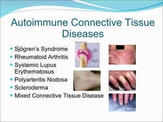 Autoimmune Connective Tissue Diseases Sjögren’s Syndrome Rheumatoid Arthritis Systemic Lupus  Erythematosus Polyarteritis Nodosa Scleroderma Mixed Connective Tissue Disease 