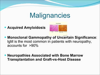 Malignancies Acquired Amyloidosis Monoclonal Gammopathy of Uncertain Significance :   IgM is the most common in patients with neuropathy, accounts for  >90% Neuropathies Associated with Bone Marrow Transplantation and Graft-vs-Host Disease 