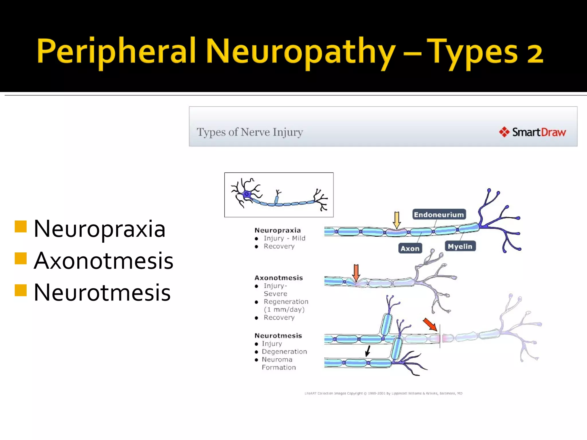  Neuropraxia
 Axonotmesis
 Neurotmesis
 