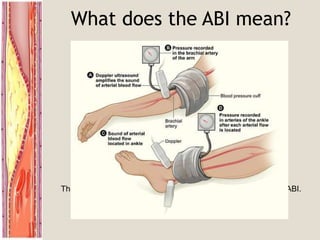 What does the ABI mean?
ABI Clinical Correlation
>0.9 Normal Limb
0.5-0.9 Intermittent Claudication
<0.4 Rest Pain
<0.15 Gangrene
CAUTION:
Patient’s with Diabetes + Renal Failure:
They have calcified arterial walls which can falsely elevate their ABI.
 