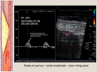 Tardus et parvus = small amplitude + slow rising pulse
 