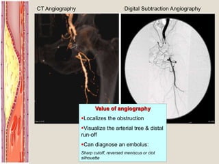 CT Angiography Digital Subtraction Angiography
Value of angiography
Localizes the obstruction
Visualize the arterial tree & distal
run-off
Can diagnose an embolus:
Sharp cutoff, reversed meniscus or clot
silhouette
 