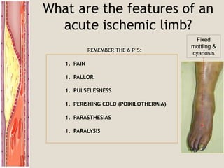 What are the features of an
acute ischemic limb?
REMEMBER THE 6 P’S:
1. PAIN
1. PALLOR
1. PULSELESNESS
1. PERISHING COLD (POIKILOTHERMIA)
1. PARASTHESIAS
1. PARALYSIS
Fixed
mottling &
cyanosis
 