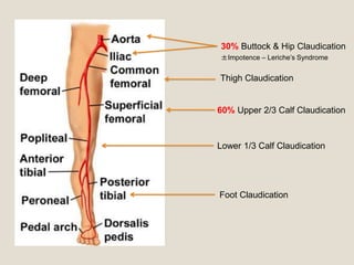 Thigh Claudication
60% Upper 2/3 Calf Claudication
Lower 1/3 Calf Claudication
Foot Claudication
30% Buttock & Hip Claudication
±Impotence – Leriche’s Syndrome
 