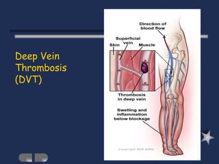 Deep Vein Thrombosis (DVT) 