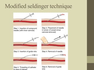 Modified seldinger technique
 