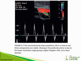 FIGURE 4-7 The normal femoral artery waveform. (A) In a limb at rest
three components are visible. Aliasing in the profunda artery is due to
the lower insonation angle giving a higher Doppler shift, not a focal
stenosis.
 