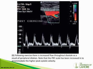 (B) Following exercise there is increased flow throughout diastole as a
result of peripheral dilation. Note that the PRF scale has been increased in to
accommodate the higher peak systolic velocity.
 