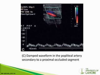 (C) Damped waveform in the popliteal artery
secondary to a proximal occluded segment
 