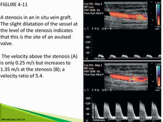 FIGURE 4-11
A stenosis in an in situ vein graft.
The slight dilatation of the vessel at
the level of the stenosis indicates
that this is the site of an avulsed
valve.
The velocity above the stenosis (A)
is only 0.25 m/s but increases to
1.35 m/s at the stenosis (B); a
velocity ratio of 5.4.
 
