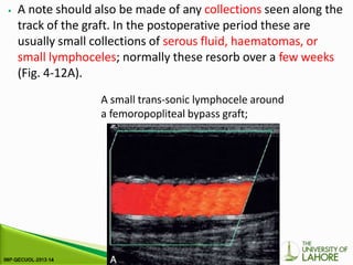 ⦁ A note should also be made of any collections seen along the
track of the graft. In the postoperative period these are
usually small collections of serous fluid, haematomas, or
small lymphoceles; normally these resorb over a few weeks
(Fig. 4-12A).
A small trans-sonic lymphocele around
a femoropopliteal bypass graft;
 