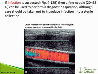 ⦁ If infection is suspected (Fig. 4-12B) then a fine needle (20–22
G) can be used to perform a diagnostic aspiration, although
care should be taken not to introduce infection into a sterile
collection.
(B) an infected fluid collection around a synthetic graft
showing low-level echoes within the fluid.
 