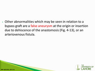 ⦁ Other abnormalities which may be seen in relation to a
bypass graft are a false aneurysm at the origin or insertion
due to dehiscence of the anastomosis (Fig. 4-13), or an
arteriovenous fistula.
 
