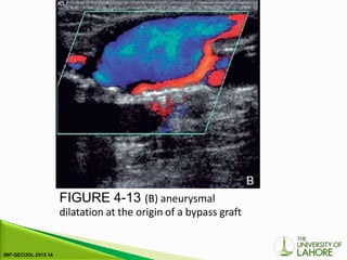 FIGURE 4-13 (B) aneurysmal
dilatation at the origin of a bypass graft
 