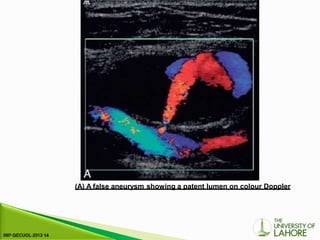 (A) A false aneurysm showing a patent lumen on colour Doppler
 