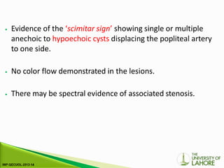⦁ Evidence of the ‘scimitar sign’ showing single or multiple
anechoic to hypoechoic cysts displacing the popliteal artery
to one side.
⦁ No color flow demonstrated in the lesions.
⦁ There may be spectral evidence of associated stenosis.
 