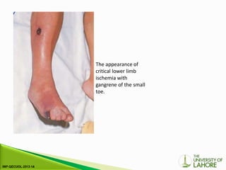 The appearance of
critical lower limb
ischemia with
gangrene of the small
toe.
 