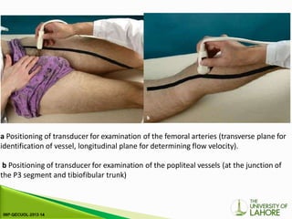 a Positioning of transducer for examination of the femoral arteries (transverse plane for
identification of vessel, longitudinal plane for determining flow velocity).
b Positioning of transducer for examination of the popliteal vessels (at the junction of
the P3 segment and tibiofibular trunk)
 