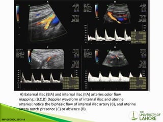 A) External iliac (EIA) and internal iliac (IIA) arteries color flow
mapping; (B,C,D) Doppler waveform of internal iliac and uterine
arteries: notice the biphasic flow of internal iliac artery (B), and uterine
artery notch presence (C) or absence (D).
 