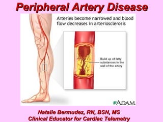 Peripheral Artery Disease Natalie Bermudez, RN, BSN, MS Clinical Educator for Cardiac Telemetry 