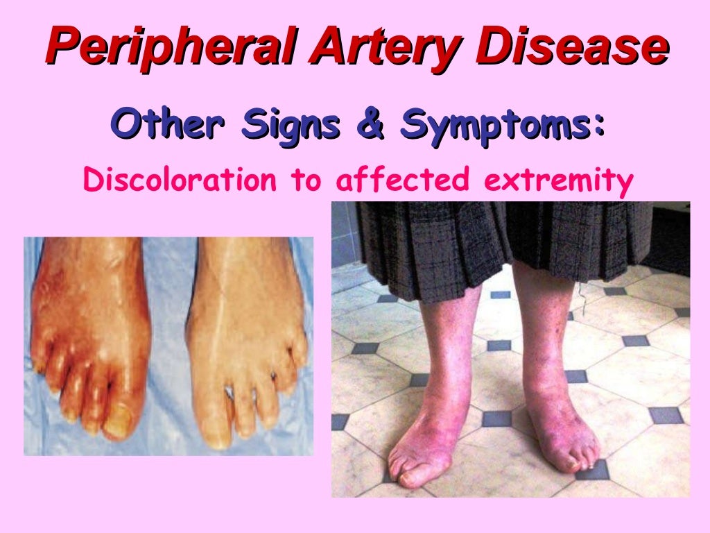 Peripheral Artery Disease BMH Tele peripheral-artery-disease-bmh-tele