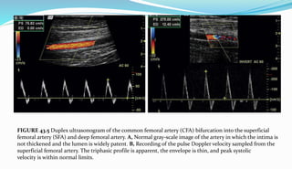 Peripheral artery disease | PPTX