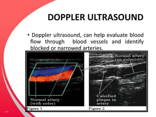 DOPPLER ULTRASOUND
• Doppler ultrasound, can help evaluate blood
flow through blood vessels and identify
blocked or narrowed arteries.
Your Footer Here 34Date
 