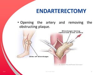 ENDARTERECTOMY
• Opening the artery and removing the
obstructing plaque.
Your Footer Here 58Date
 