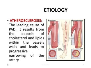 ETIOLOGY
• ATHEROSCLEROSIS:
The leading cause of
PAD. It results from
the deposit of
cholesterol and lipids
within the vessels
walls and leads to
progressive
narrowing of the
artery.
•Date Your Footer Here 9
 