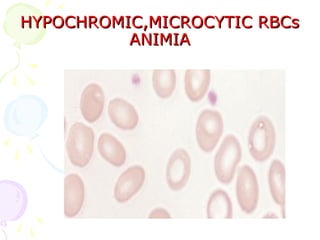 HYPOCHROMIC,MICROCYTIC RBCs
          ANIMIA
 