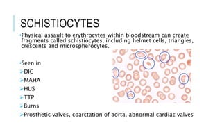 SCHISTIOCYTES
•Physical assault to erythrocytes within bloodstream can create
fragments called schistiocytes, including helmet cells, triangles,
crescents and microspherocytes.
•Seen in
DIC
MAHA
HUS
TTP
Burns
Prosthetic valves, coarctation of aorta, abnormal cardiac valves
 