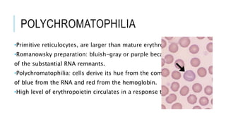 POLYCHROMATOPHILIA
•Primitive reticulocytes, are larger than mature erythrocytes.
•Romanowsky preparation: bluish-gray or purple because
of the substantial RNA remnants.
•Polychromatophilia: cells derive its hue from the combination
of blue from the RNA and red from the hemoglobin.
•High level of erythropoietin circulates in a response to anemia.
 