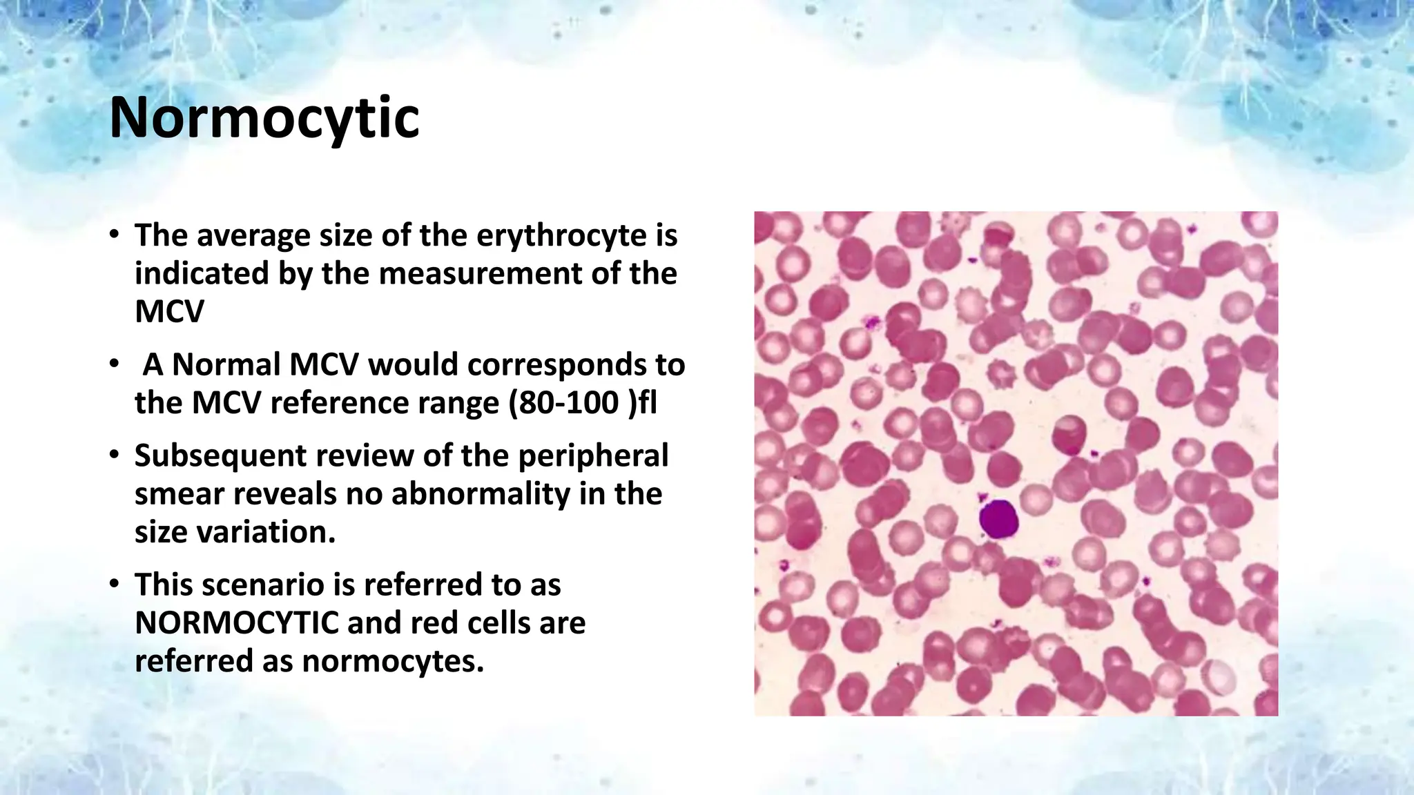 Normocytic
• The average size of the erythrocyte is
indicated by the measurement of the
MCV
• A Normal MCV would corresponds to
the MCV reference range (80-100 )fl
• Subsequent review of the peripheral
smear reveals no abnormality in the
size variation.
• This scenario is referred to as
NORMOCYTIC and red cells are
referred as normocytes.
 