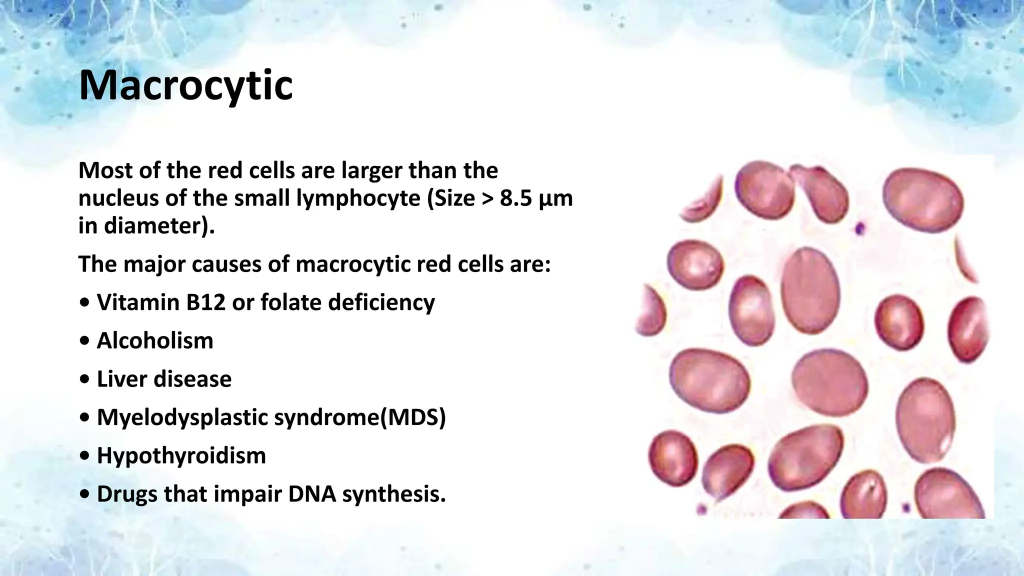Macrocytic
Most of the red cells are larger than the
nucleus of the small lymphocyte (Size > 8.5 μm
in diameter).
The major causes of macrocytic red cells are:
• Vitamin B12 or folate deficiency
• Alcoholism
• Liver disease
• Myelodysplastic syndrome(MDS)
• Hypothyroidism
• Drugs that impair DNA synthesis.
 
