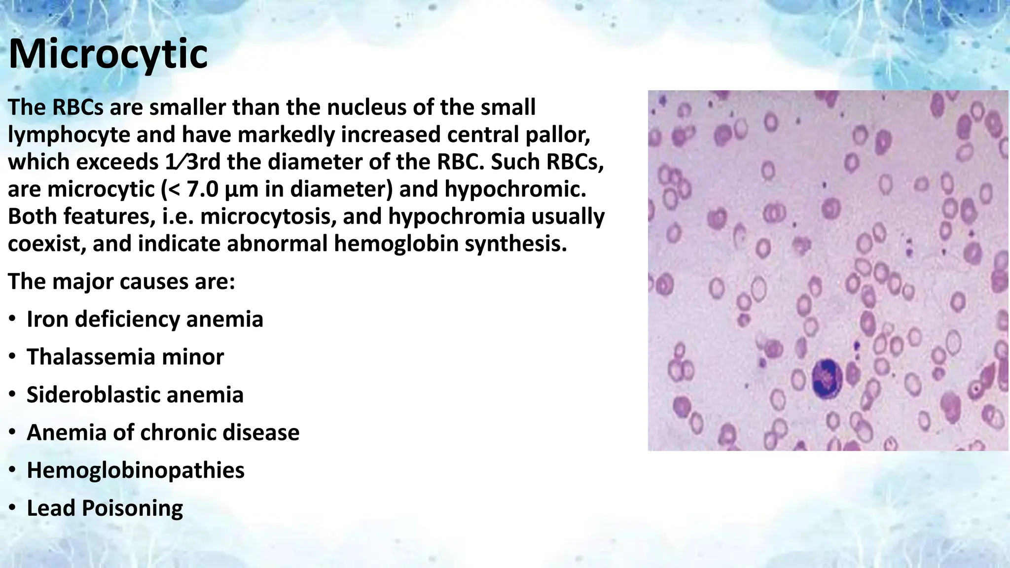 Microcytic
The RBCs are smaller than the nucleus of the small
lymphocyte and have markedly increased central pallor,
which exceeds 1⁄3rd the diameter of the RBC. Such RBCs,
are microcytic (< 7.0 μm in diameter) and hypochromic.
Both features, i.e. microcytosis, and hypochromia usually
coexist, and indicate abnormal hemoglobin synthesis.
The major causes are:
• Iron deficiency anemia
• Thalassemia minor
• Sideroblastic anemia
• Anemia of chronic disease
• Hemoglobinopathies
• Lead Poisoning
 