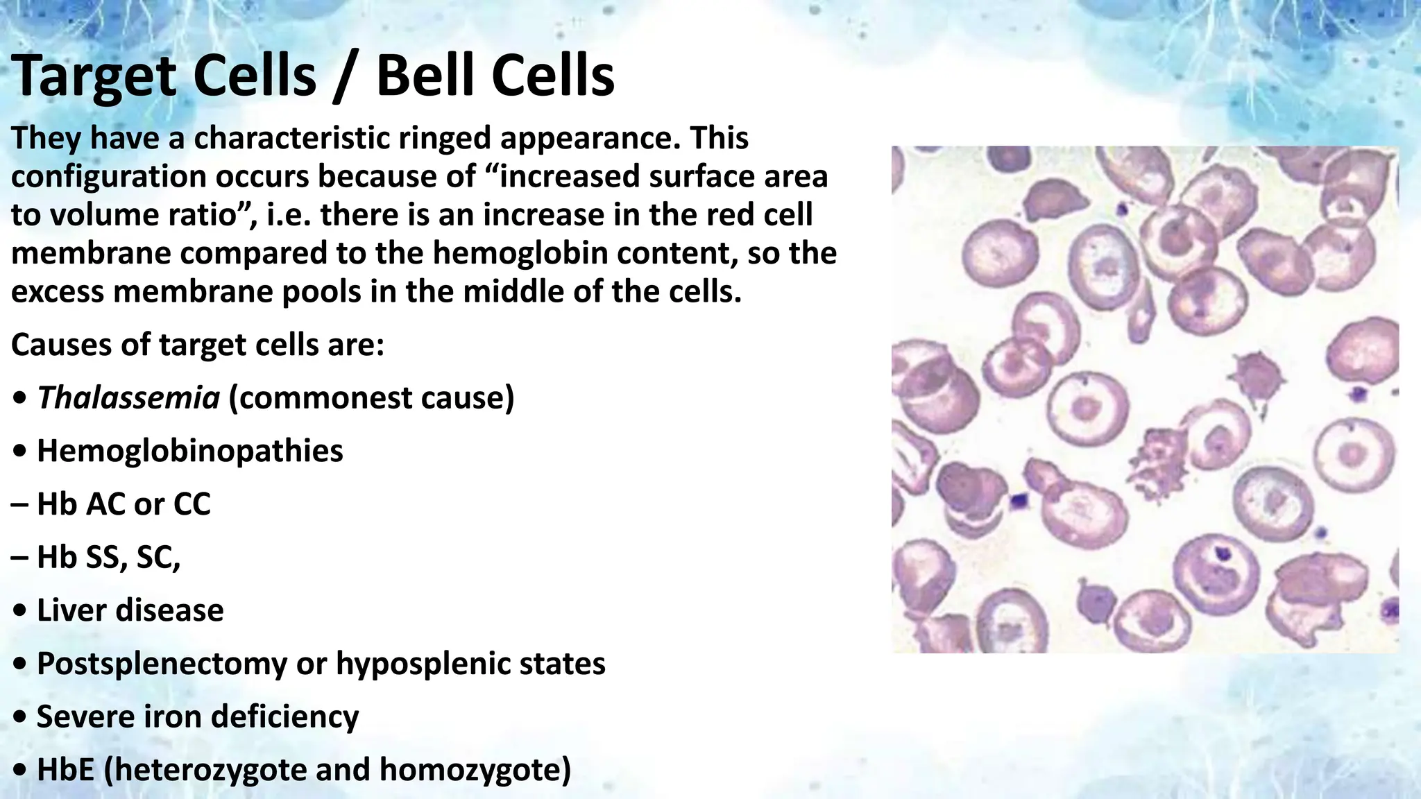 Target Cells / Bell Cells
They have a characteristic ringed appearance. This
configuration occurs because of “increased surface area
to volume ratio”, i.e. there is an increase in the red cell
membrane compared to the hemoglobin content, so the
excess membrane pools in the middle of the cells.
Causes of target cells are:
• Thalassemia (commonest cause)
• Hemoglobinopathies
– Hb AC or CC
– Hb SS, SC,
• Liver disease
• Postsplenectomy or hyposplenic states
• Severe iron deficiency
• HbE (heterozygote and homozygote)
 