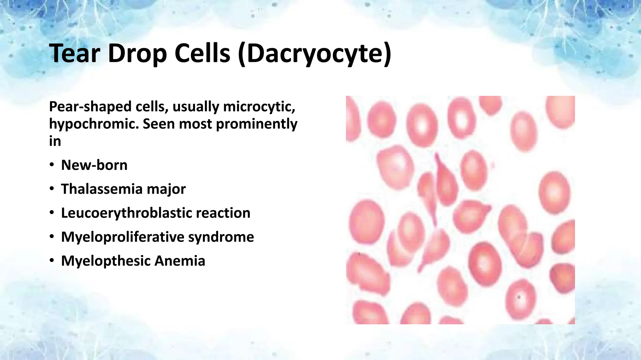 Tear Drop Cells (Dacryocyte)
Pear-shaped cells, usually microcytic,
hypochromic. Seen most prominently
in
• New-born
• Thalassemia major
• Leucoerythroblastic reaction
• Myeloproliferative syndrome
• Myelopthesic Anemia
 
