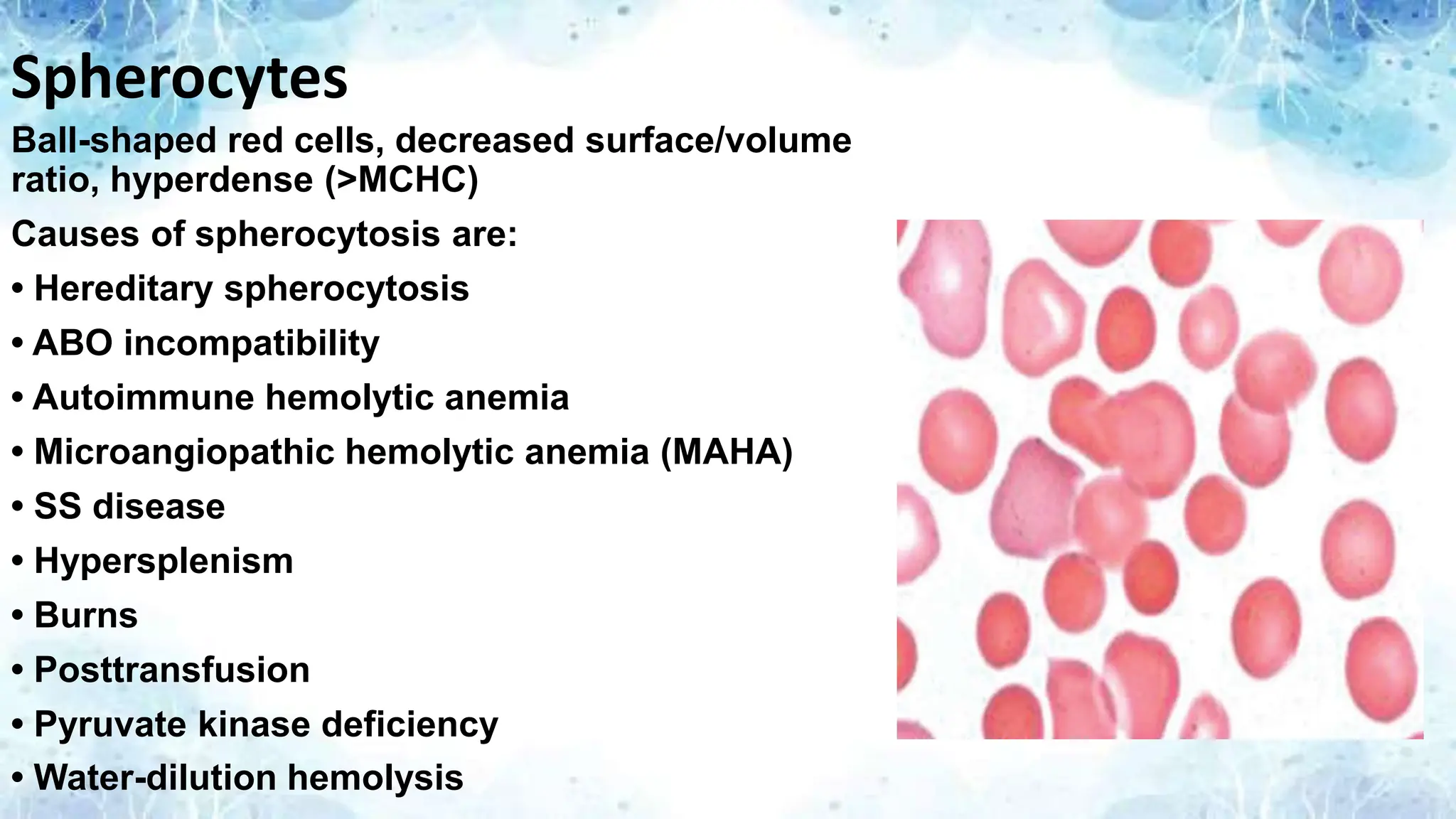 Spherocytes
Ball-shaped red cells, decreased surface/volume
ratio, hyperdense (>MCHC)
Causes of spherocytosis are:
• Hereditary spherocytosis
• ABO incompatibility
• Autoimmune hemolytic anemia
• Microangiopathic hemolytic anemia (MAHA)
• SS disease
• Hypersplenism
• Burns
• Posttransfusion
• Pyruvate kinase deficiency
• Water-dilution hemolysis
 