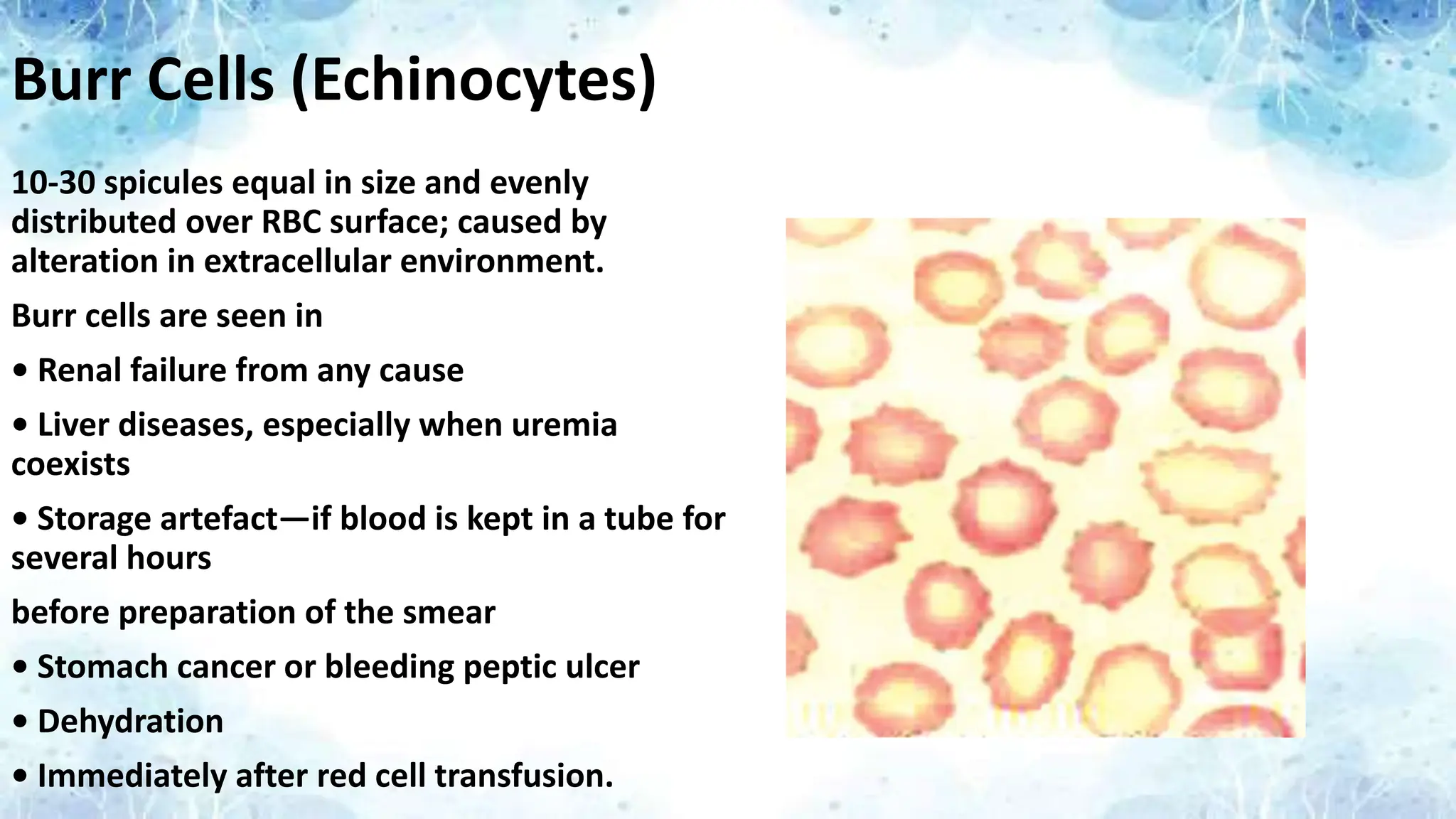 Burr Cells (Echinocytes)
10-30 spicules equal in size and evenly
distributed over RBC surface; caused by
alteration in extracellular environment.
Burr cells are seen in
• Renal failure from any cause
• Liver diseases, especially when uremia
coexists
• Storage artefact—if blood is kept in a tube for
several hours
before preparation of the smear
• Stomach cancer or bleeding peptic ulcer
• Dehydration
• Immediately after red cell transfusion.
 