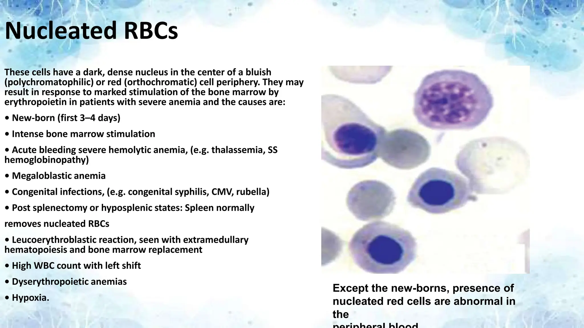 Nucleated RBCs
These cells have a dark, dense nucleus in the center of a bluish
(polychromatophilic) or red (orthochromatic) cell periphery. They may
result in response to marked stimulation of the bone marrow by
erythropoietin in patients with severe anemia and the causes are:
• New-born (first 3–4 days)
• Intense bone marrow stimulation
• Acute bleeding severe hemolytic anemia, (e.g. thalassemia, SS
hemoglobinopathy)
• Megaloblastic anemia
• Congenital infections, (e.g. congenital syphilis, CMV, rubella)
• Post splenectomy or hyposplenic states: Spleen normally
removes nucleated RBCs
• Leucoerythroblastic reaction, seen with extramedullary
hematopoiesis and bone marrow replacement
• High WBC count with left shift
• Dyserythropoietic anemias
• Hypoxia.
Except the new-borns, presence of
nucleated red cells are abnormal in
the
 