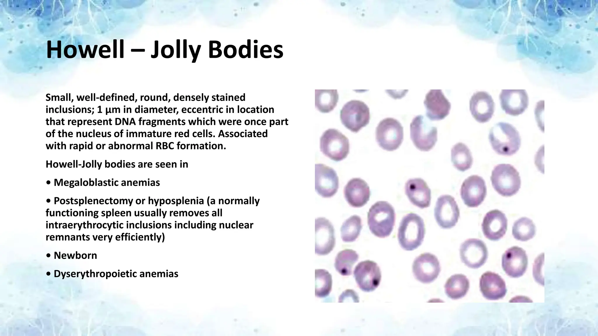 Howell – Jolly Bodies
Small, well-defined, round, densely stained
inclusions; 1 μm in diameter, eccentric in location
that represent DNA fragments which were once part
of the nucleus of immature red cells. Associated
with rapid or abnormal RBC formation.
Howell-Jolly bodies are seen in
• Megaloblastic anemias
• Postsplenectomy or hyposplenia (a normally
functioning spleen usually removes all
intraerythrocytic inclusions including nuclear
remnants very efficiently)
• Newborn
• Dyserythropoietic anemias
 