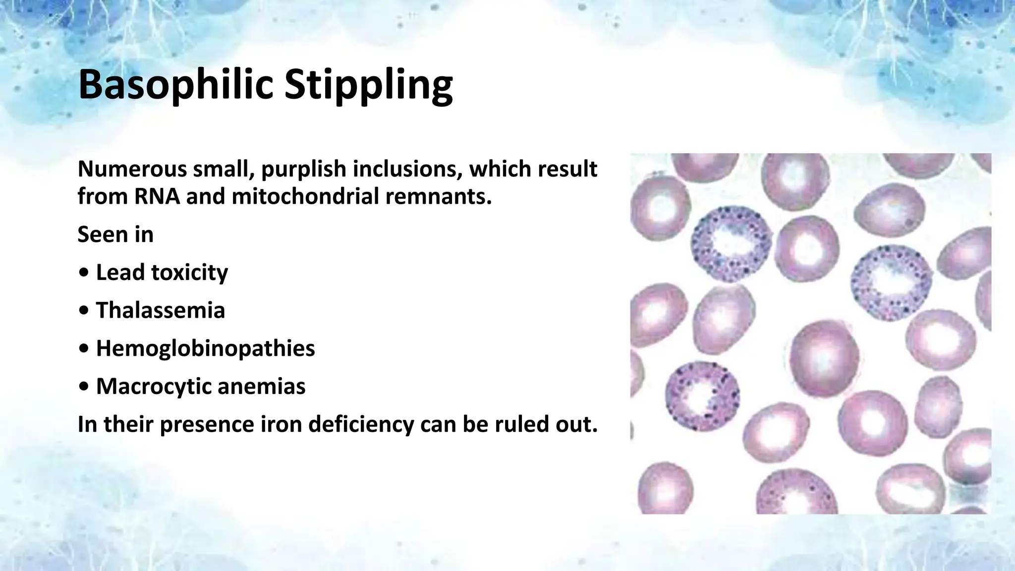 Basophilic Stippling
Numerous small, purplish inclusions, which result
from RNA and mitochondrial remnants.
Seen in
• Lead toxicity
• Thalassemia
• Hemoglobinopathies
• Macrocytic anemias
In their presence iron deficiency can be ruled out.
 