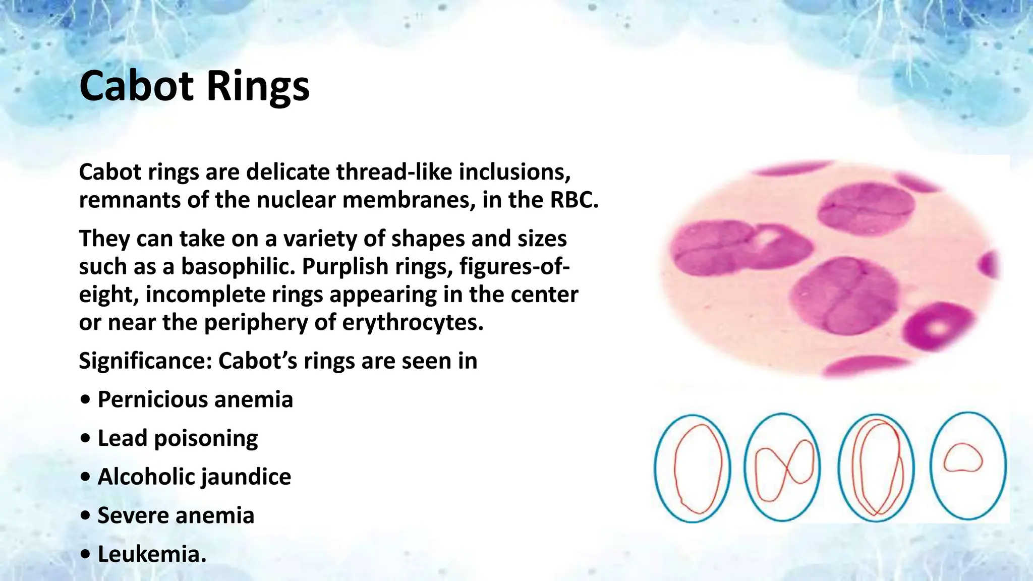Cabot Rings
Cabot rings are delicate thread-like inclusions,
remnants of the nuclear membranes, in the RBC.
They can take on a variety of shapes and sizes
such as a basophilic. Purplish rings, figures-of-
eight, incomplete rings appearing in the center
or near the periphery of erythrocytes.
Significance: Cabot’s rings are seen in
• Pernicious anemia
• Lead poisoning
• Alcoholic jaundice
• Severe anemia
• Leukemia.
 