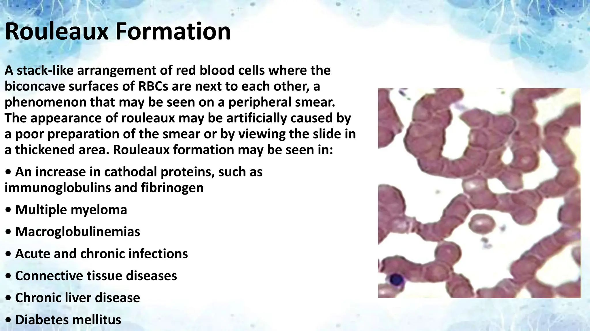 Rouleaux Formation
A stack-like arrangement of red blood cells where the
biconcave surfaces of RBCs are next to each other, a
phenomenon that may be seen on a peripheral smear.
The appearance of rouleaux may be artificially caused by
a poor preparation of the smear or by viewing the slide in
a thickened area. Rouleaux formation may be seen in:
• An increase in cathodal proteins, such as
immunoglobulins and fibrinogen
• Multiple myeloma
• Macroglobulinemias
• Acute and chronic infections
• Connective tissue diseases
• Chronic liver disease
• Diabetes mellitus
 