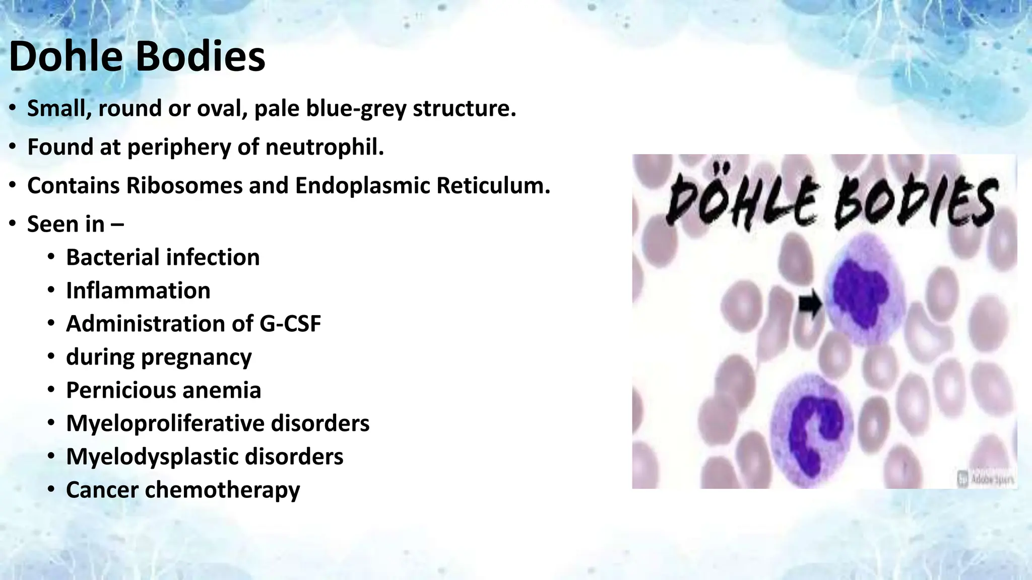 Dohle Bodies
• Small, round or oval, pale blue-grey structure.
• Found at periphery of neutrophil.
• Contains Ribosomes and Endoplasmic Reticulum.
• Seen in –
• Bacterial infection
• Inflammation
• Administration of G-CSF
• during pregnancy
• Pernicious anemia
• Myeloproliferative disorders
• Myelodysplastic disorders
• Cancer chemotherapy
 