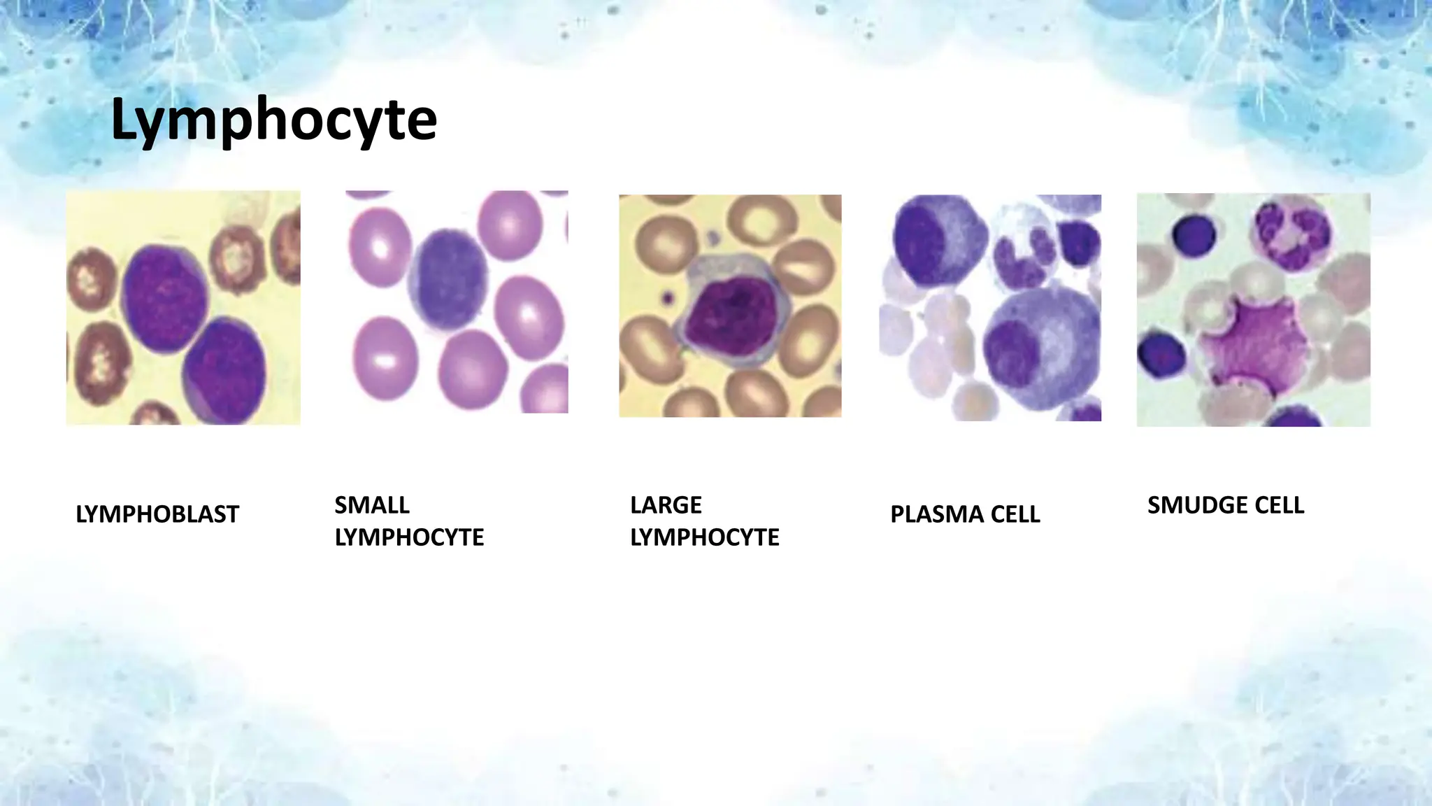 Lymphocyte
LYMPHOBLAST SMALL
LYMPHOCYTE
LARGE
LYMPHOCYTE
PLASMA CELL SMUDGE CELL
 