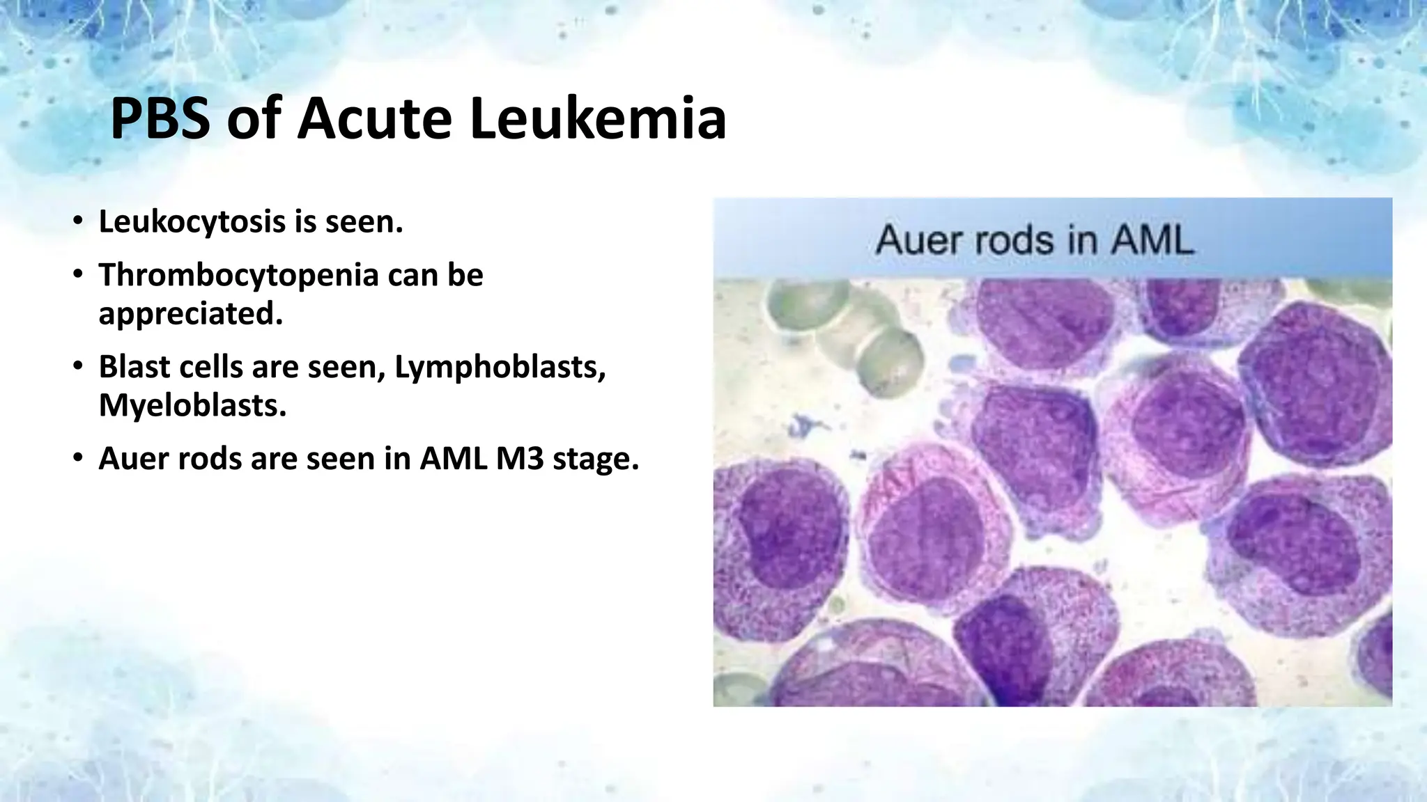 PBS of Acute Leukemia
• Leukocytosis is seen.
• Thrombocytopenia can be
appreciated.
• Blast cells are seen, Lymphoblasts,
Myeloblasts.
• Auer rods are seen in AML M3 stage.
 